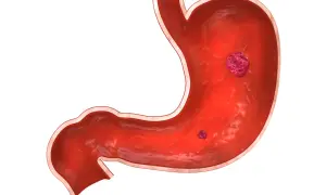 Sezione interna di uno stomaco con due lesioni che indicano un'ulcera gastrica.