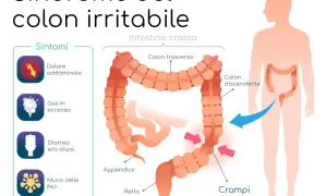 Illustrazione della sindrome del colon irritabile, con sintomi come dolore addominale e crampi. Il colon infiammato è evidenziato.