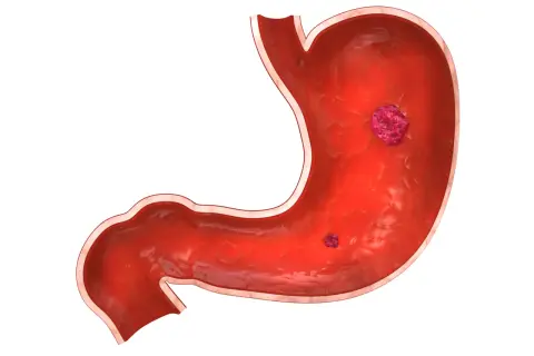 Sezione interna di uno stomaco con due lesioni che indicano un'ulcera gastrica.