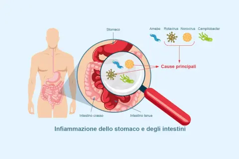 Illustrazione di un corpo umano con ingrandimento dello stomaco e degli intestini, mostrando i microrganismi causa di un virus intestinale 2026.