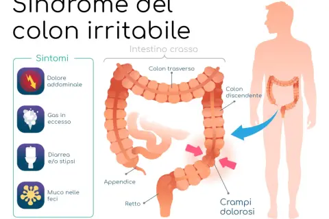 Illustrazione della sindrome del colon irritabile, con sintomi come dolore addominale e crampi. Il colon infiammato è evidenziato.