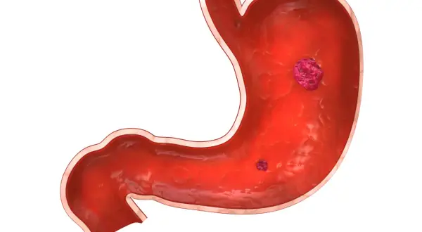 Sezione interna di uno stomaco con due lesioni che indicano un'ulcera gastrica.