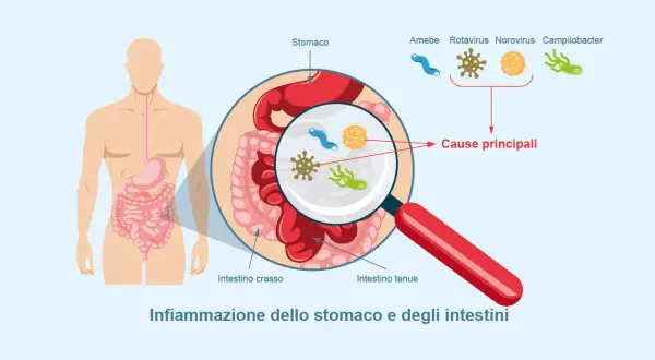 Illustrazione di un corpo umano con ingrandimento dello stomaco e degli intestini, mostrando i microrganismi causa di un virus intestinale 2026.