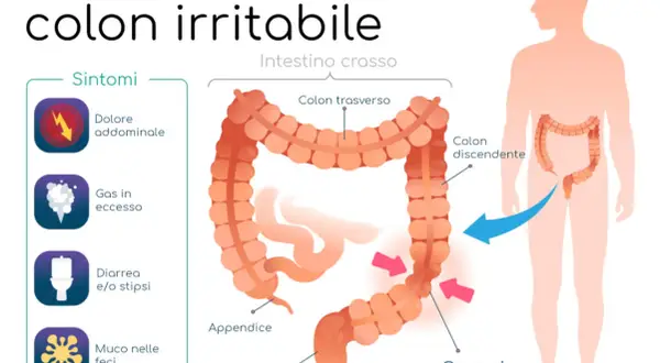 Illustrazione della sindrome del colon irritabile, con sintomi come dolore addominale e crampi. Il colon infiammato è evidenziato.
