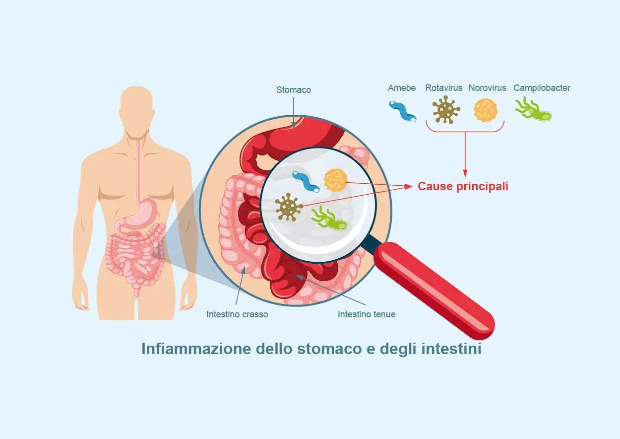 Illustrazione di un corpo umano con ingrandimento dello stomaco e degli intestini, mostrando i microrganismi causa di un virus intestinale 2026.