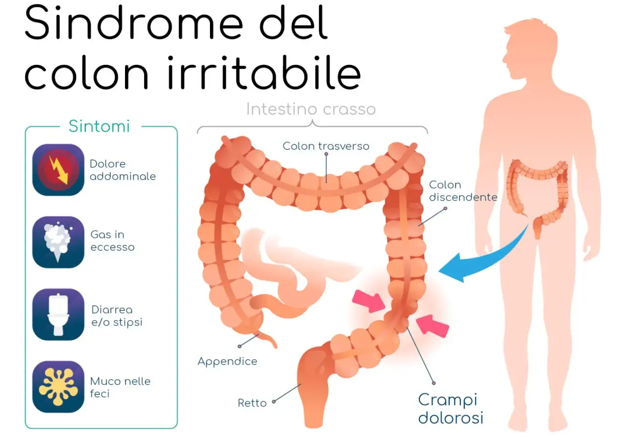 Illustrazione della sindrome del colon irritabile, con sintomi come dolore addominale e crampi. Il colon infiammato è evidenziato.