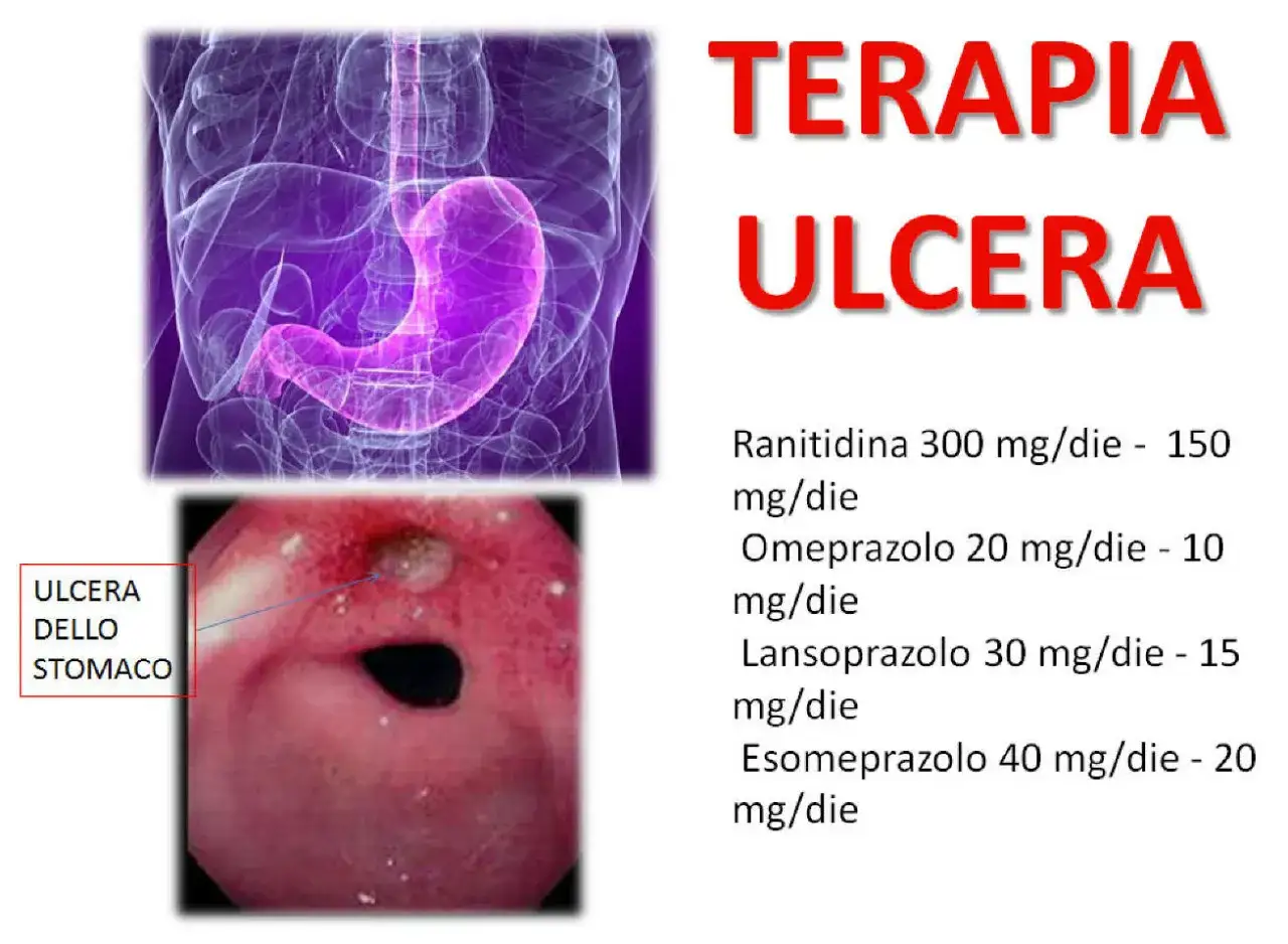 Immagine mostra un'ulcera gastrica e la terapia con farmaci come Ranitidina e Omeprazolo.