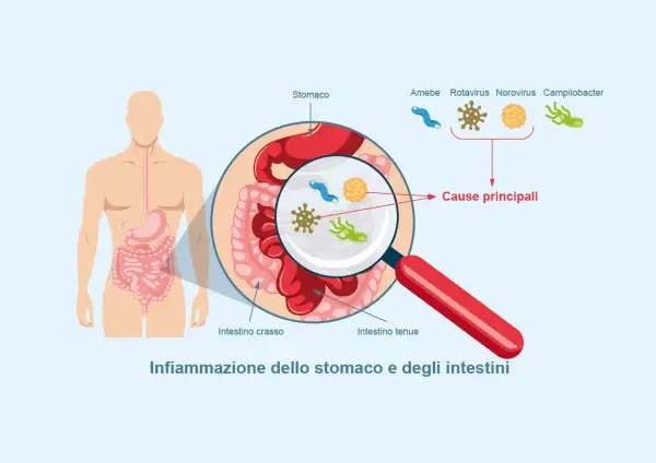 Illustrazione di un corpo umano con ingrandimento dello stomaco e degli intestini, mostrando i microrganismi causa di un virus intestinale 2026.