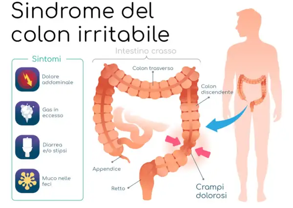 Illustrazione della sindrome del colon irritabile, con sintomi come dolore addominale e crampi. Il colon infiammato è evidenziato.